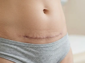 Caesarean Section (C-Section) Recovery