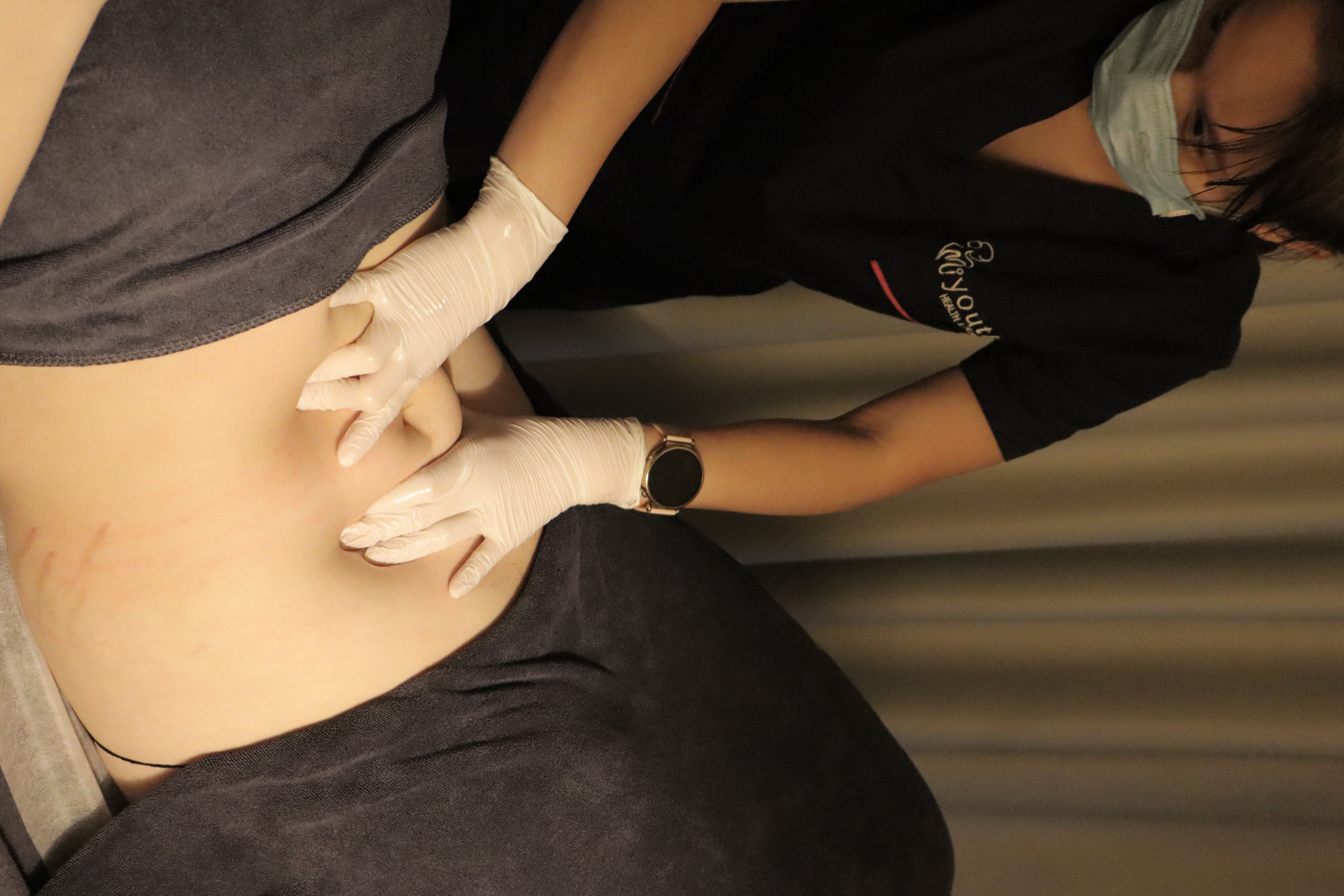 Rectus Abdominis Closure Treatment