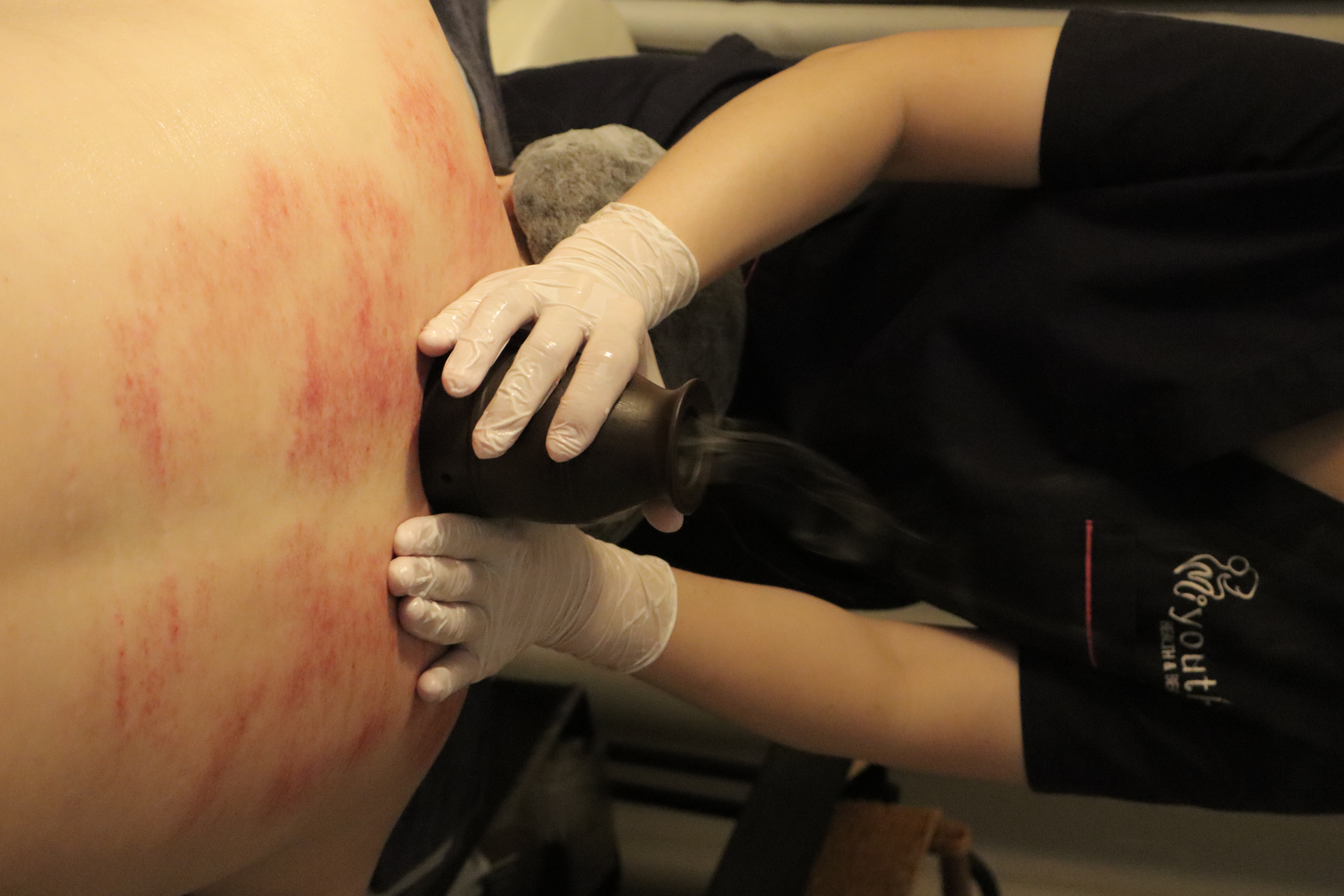 Herbal Back Treatment