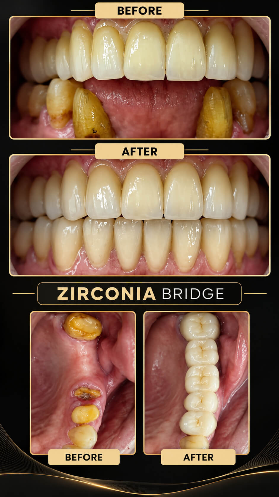 Zirconia Bridge — before and after dental case study