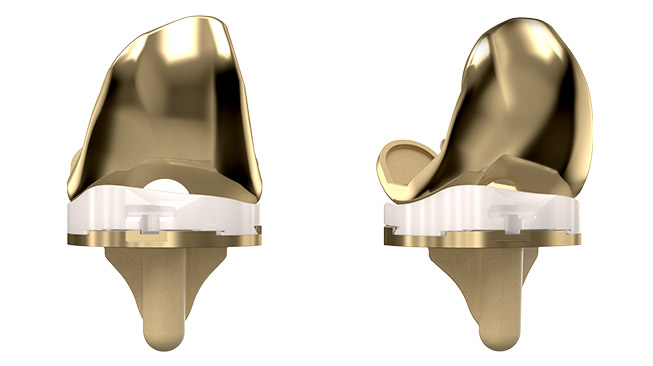 Componenti della protesi di ginocchio Evolution Nitrx Medial-Pivot Knee System (MICROPORT): componente femorale, inserto in polietilene e componente tibiale visti da due angolazioni.