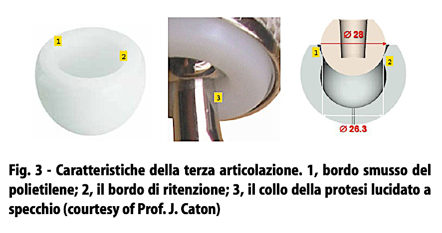 Caratteristiche della terza articolazione: bordo smusso del polietilene, bordo di ritenzione e collo della protesi lucidato a specchio (Fig. 3).