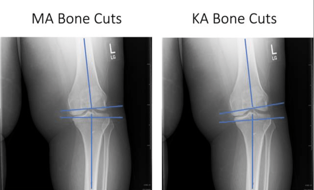 Confronto radiografico dei piani di taglio osseo: allineamento meccanico (MA Bone Cuts) a sinistra e allineamento cinematico (KA Bone Cuts) a destra.