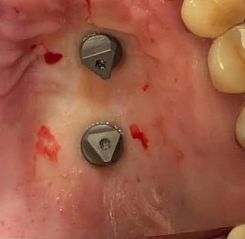 Fiducial markers placed in palatal tissue