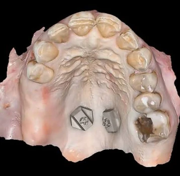 3D scan showing fiducial marker placement