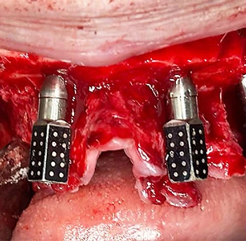 Surgical photo showing iCamBody markers placed on dental implants in the mouth