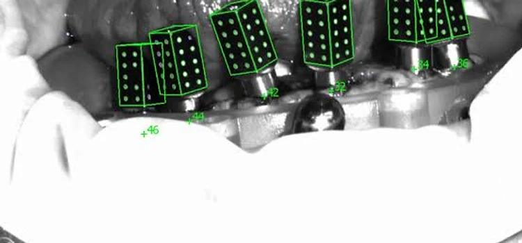 Grayscale intraoral scan showing iCamBody markers recognized by software with green overlays and position labels