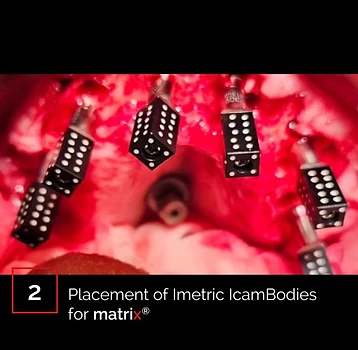 Placement of Imetric iCamBodies for matrix system