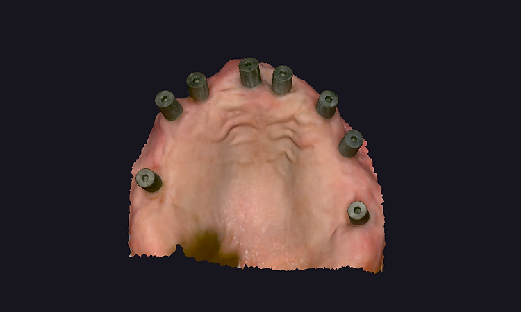 3D scan model of upper jaw with healing abutments placed at implant positions