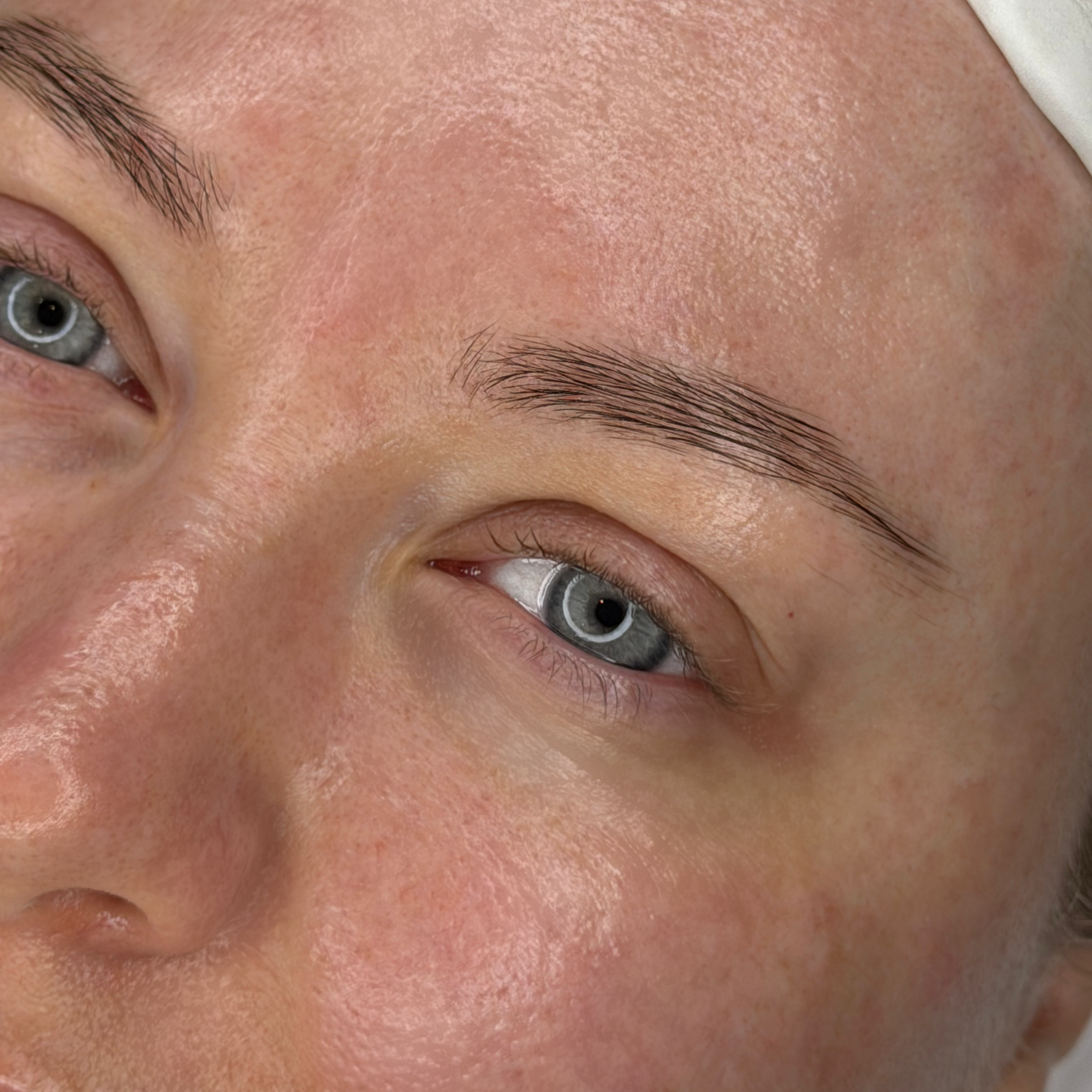 Hydrafacial kezelés