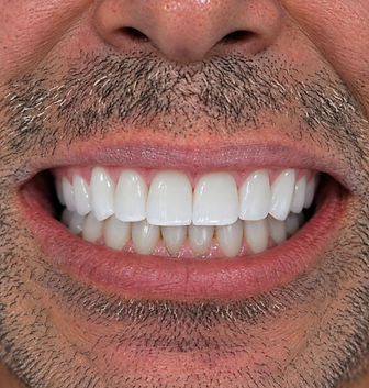 Resultado: Reabilitação Oral — transformação do sorriso