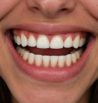 Resultado: Fechamento de Diastema — transformação do sorriso