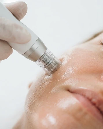 Microneedling