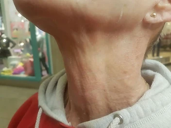 Neck Firmness Progress after