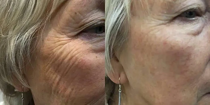 Facial Firmness Progress after