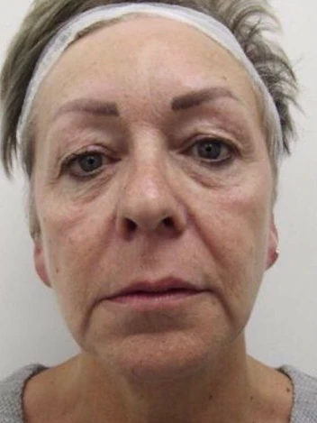 Facial Firmness & Tone Progress before