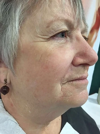 Facial Lines & Firmness Progress after