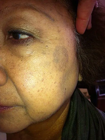 Tone & Pigmentation Progress before