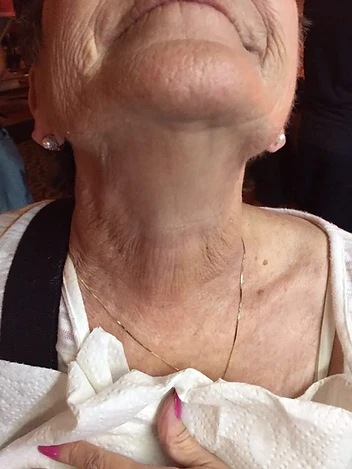 Neck Texture & Firmness Progress after