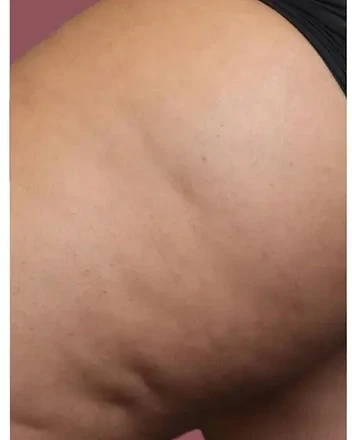 TriPollar Body RF + DMA Reference before