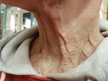 Neck Firmness Progress before
