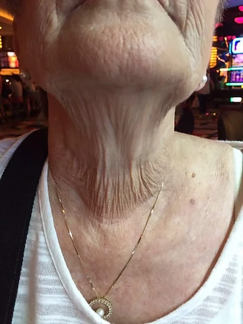 Neck Texture & Firmness Progress before