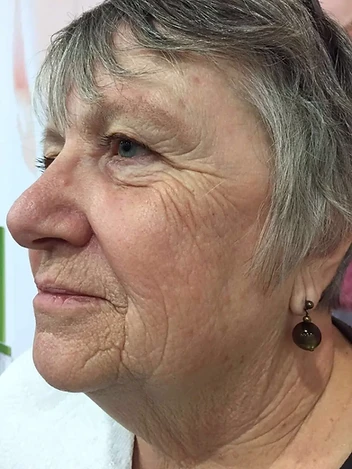 Facial Lines & Firmness Progress before