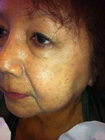 Tone & Pigmentation Progress after