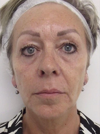 Facial Firmness & Tone Progress after