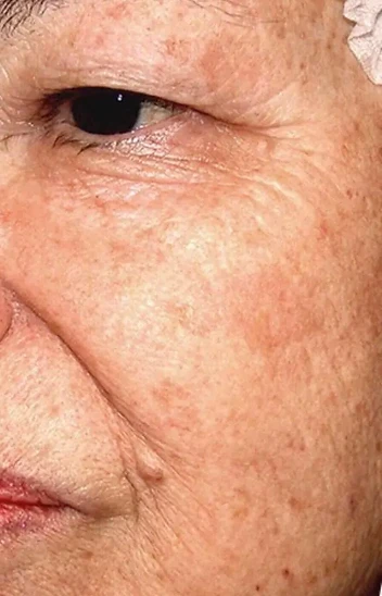 Visible Pigmentation Progress after