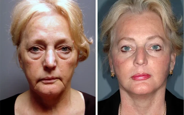 Mature Skin Firmness Progress after