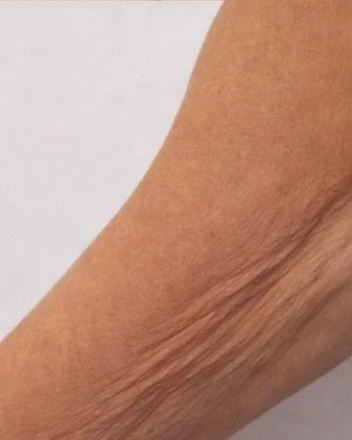 Upper-Arm Firmness Reference before