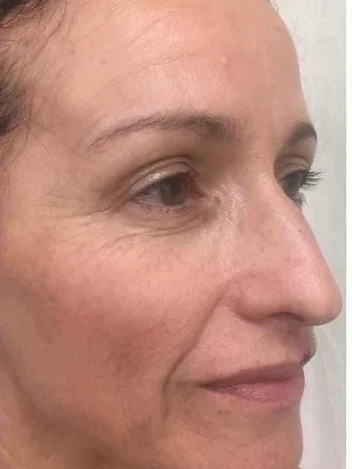 Lines, Lift & Tone Progress after