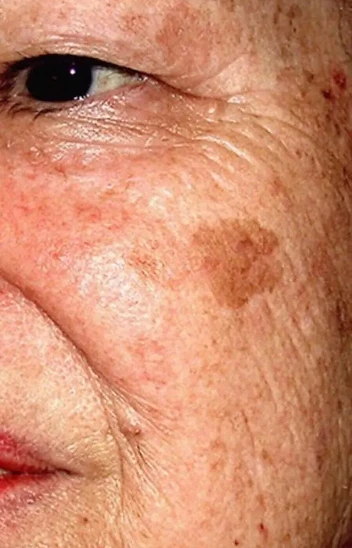 Visible Pigmentation Progress before