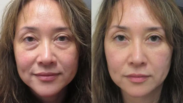 Under-Eye & Facial Firmness Progress after