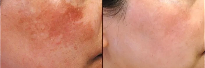 Pigmentation & Redness Progress after