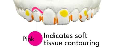 Gingival Reshaping (if applicable)