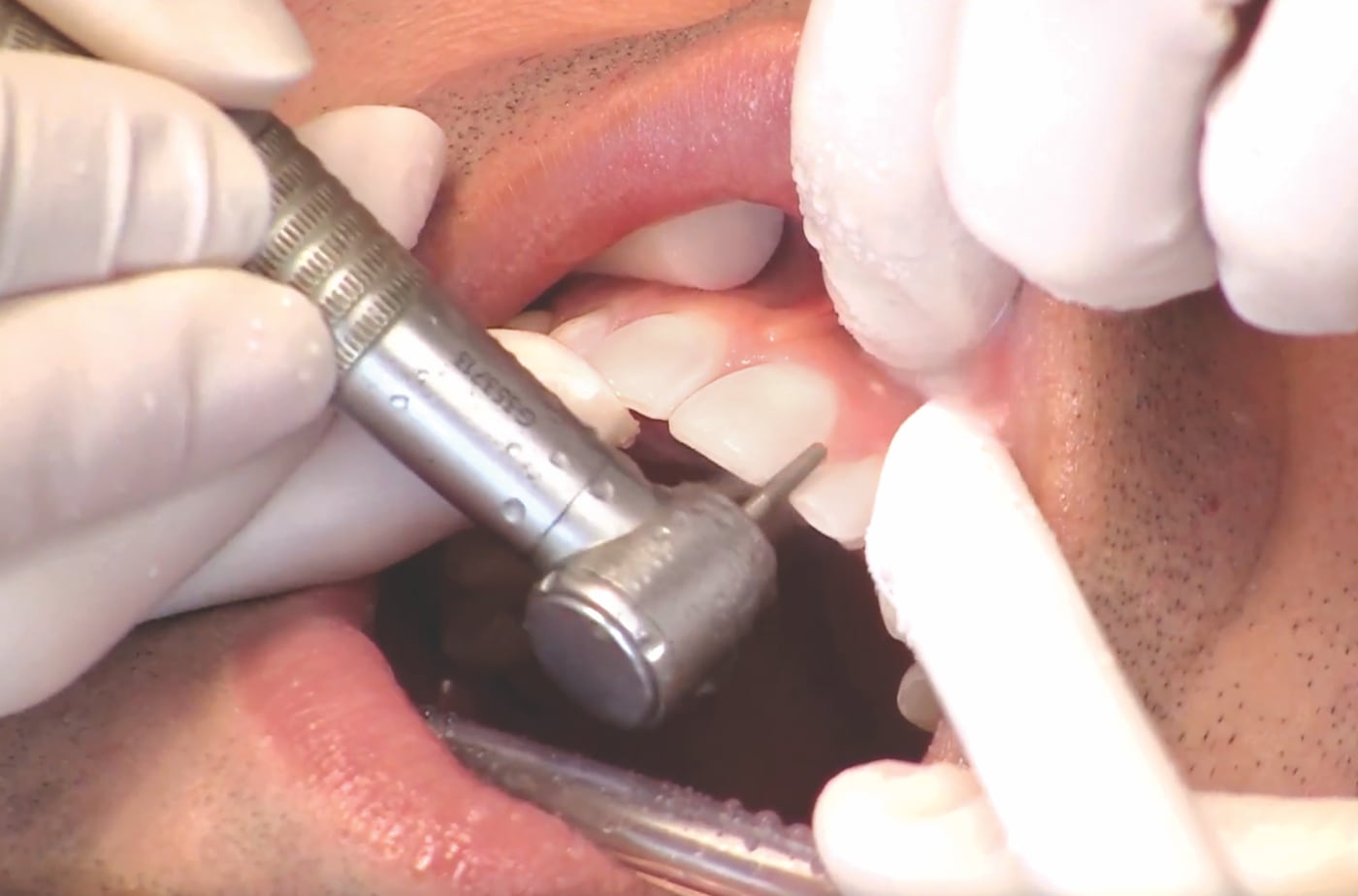 Final Adjustments & Softening detail