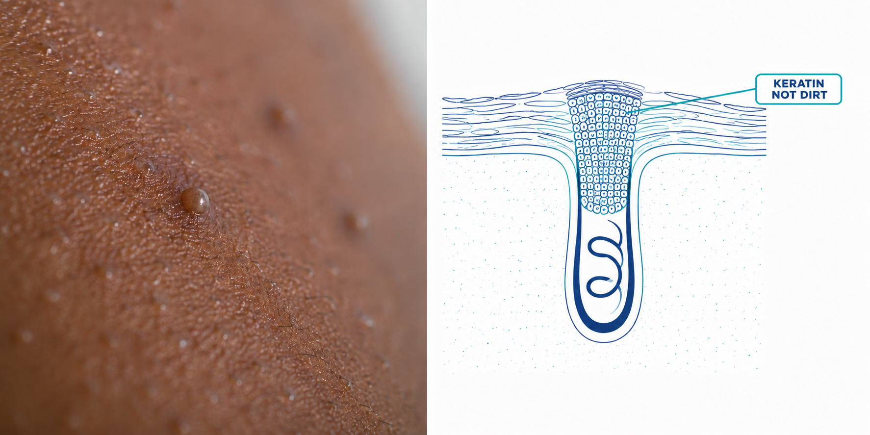 Split panel: close-up of bumpy skin on a dark complexion beside a cross-section diagram of a hair follicle with a callout to the keratin plug labelled keratin not dirt