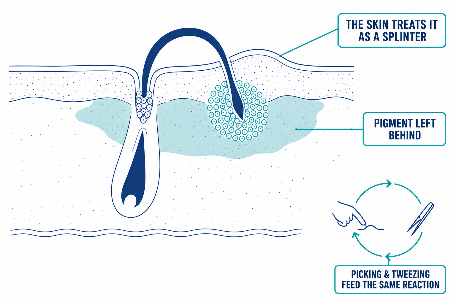 Cross-section diagram of a hair follicle under the skin surrounded by immune cells and inflammation, with a process icon of a hand pointing to a bump and tweezers