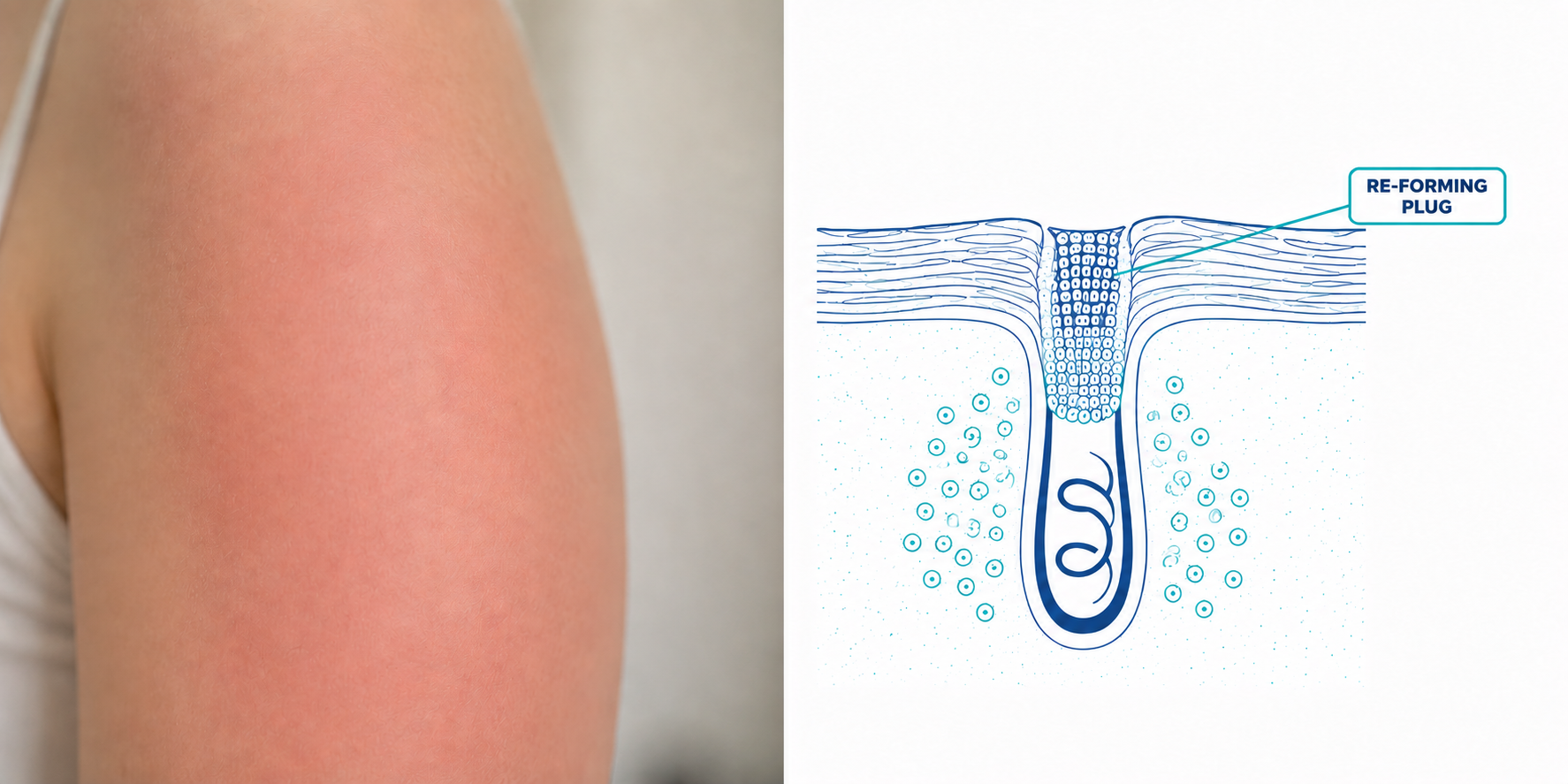 Split panel: close-up of reddish inflamed skin beside a cross-section diagram of a hair follicle with a callout to the re-forming keratin plug