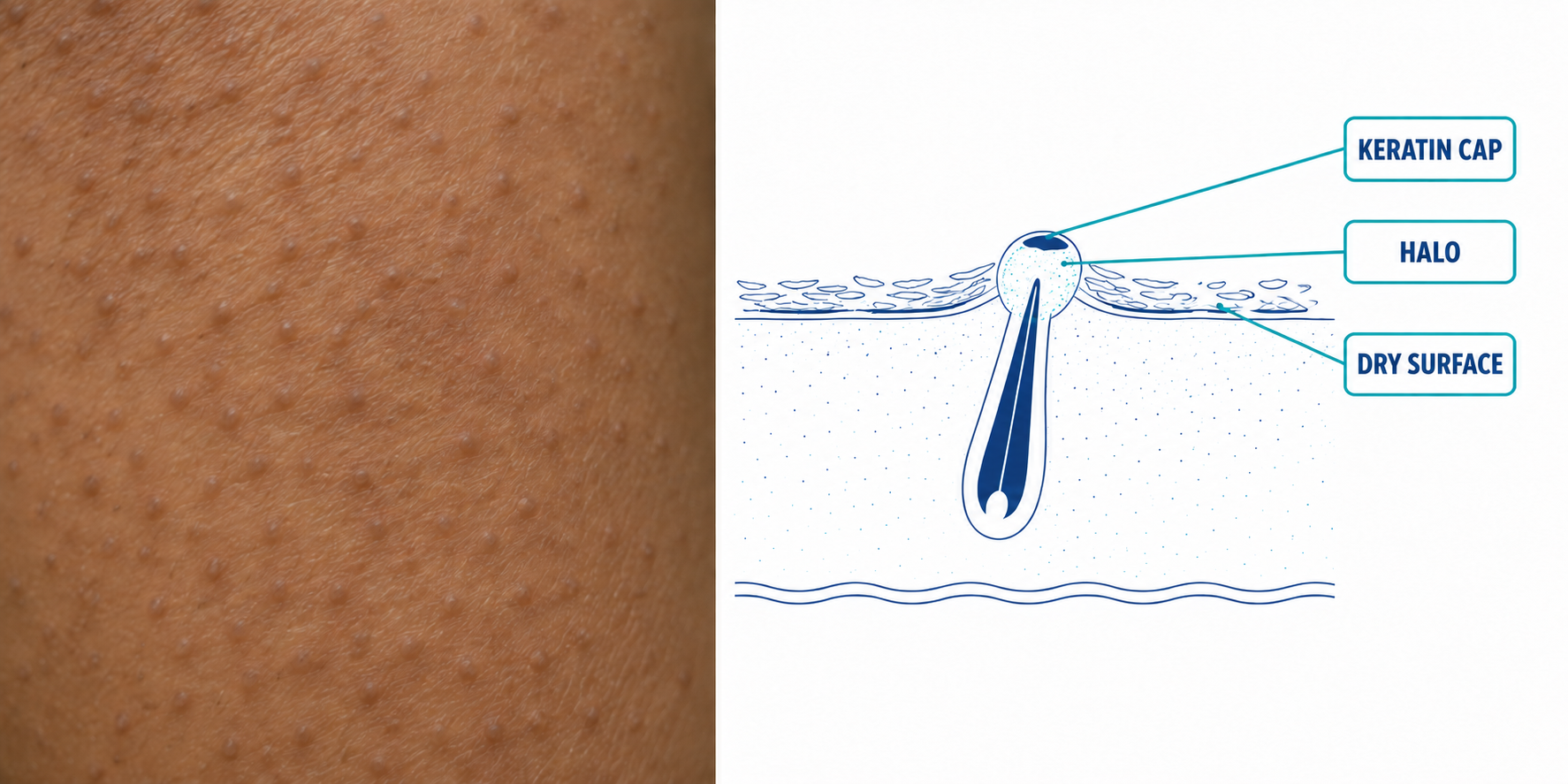 Split panel: close-up of keratosis pilaris bumps on light-brown skin beside a cross-section diagram of a single plugged follicle with callouts to the keratin cap, the halo and the dry surface