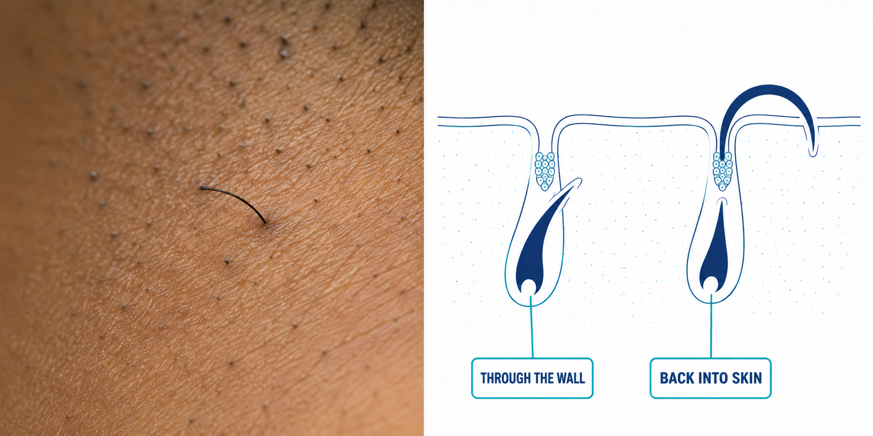 Split panel: macro photograph of skin with stubble beside a diagram of two hair follicles, one curving back into the skin as an ingrown hair and one growing straight out