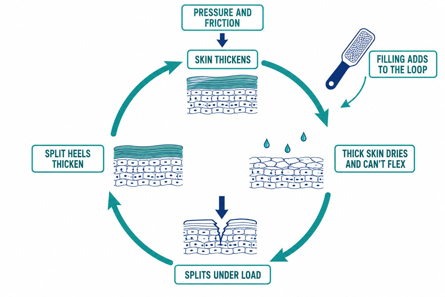 Circular teal diagram of the callus–crack cycle: pressure and friction, skin thickens, thick skin dries and cannot flex, splits under load, split heels thicken — with filing adding to the loop
