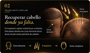 02. Trasplante capilar. Recuperar cabello donde ya falta. El trasplante capilar redistribuye unidades foliculares desde una zona donante hacia áreas donde existe pérdida de cabello. Zona donante → Trasplante → Zona receptora.