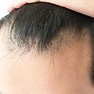 Tipo de alopecia: Alopecia Androgénica — diagnóstico capilar FOLIMAX