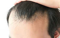 Tipo de alopecia: Alopecia Androgénica — diagnóstico capilar FOLIMAX