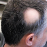 Tipo de alopecia: Alopecia Areata — diagnóstico capilar FOLIMAX
