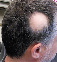 Tipo de alopecia: Alopecia Areata — diagnóstico capilar FOLIMAX