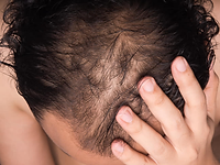 Tipo de alopecia: Alopecia Difusa — diagnóstico capilar FOLIMAX